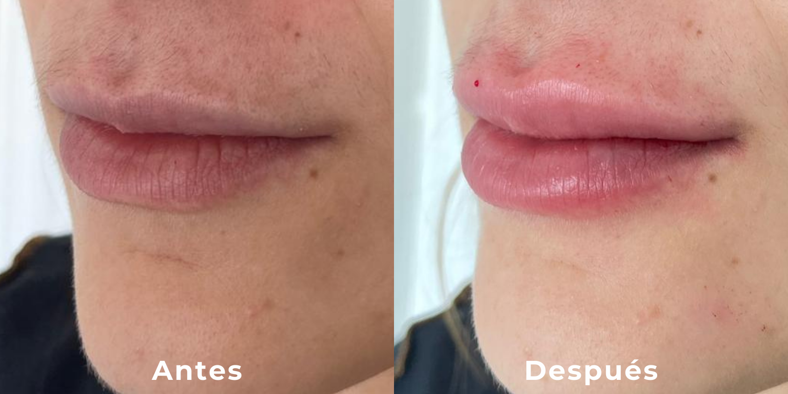 aumento de labios